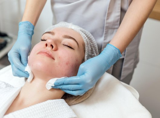 Лечение прыщей